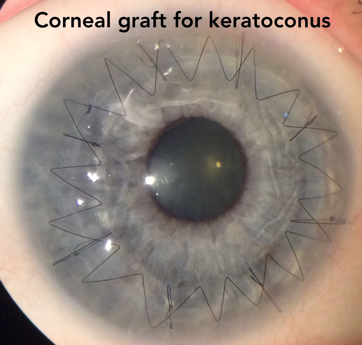 Keratoconus surgery recovery time