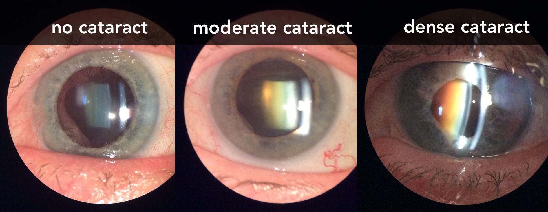 cataract progression