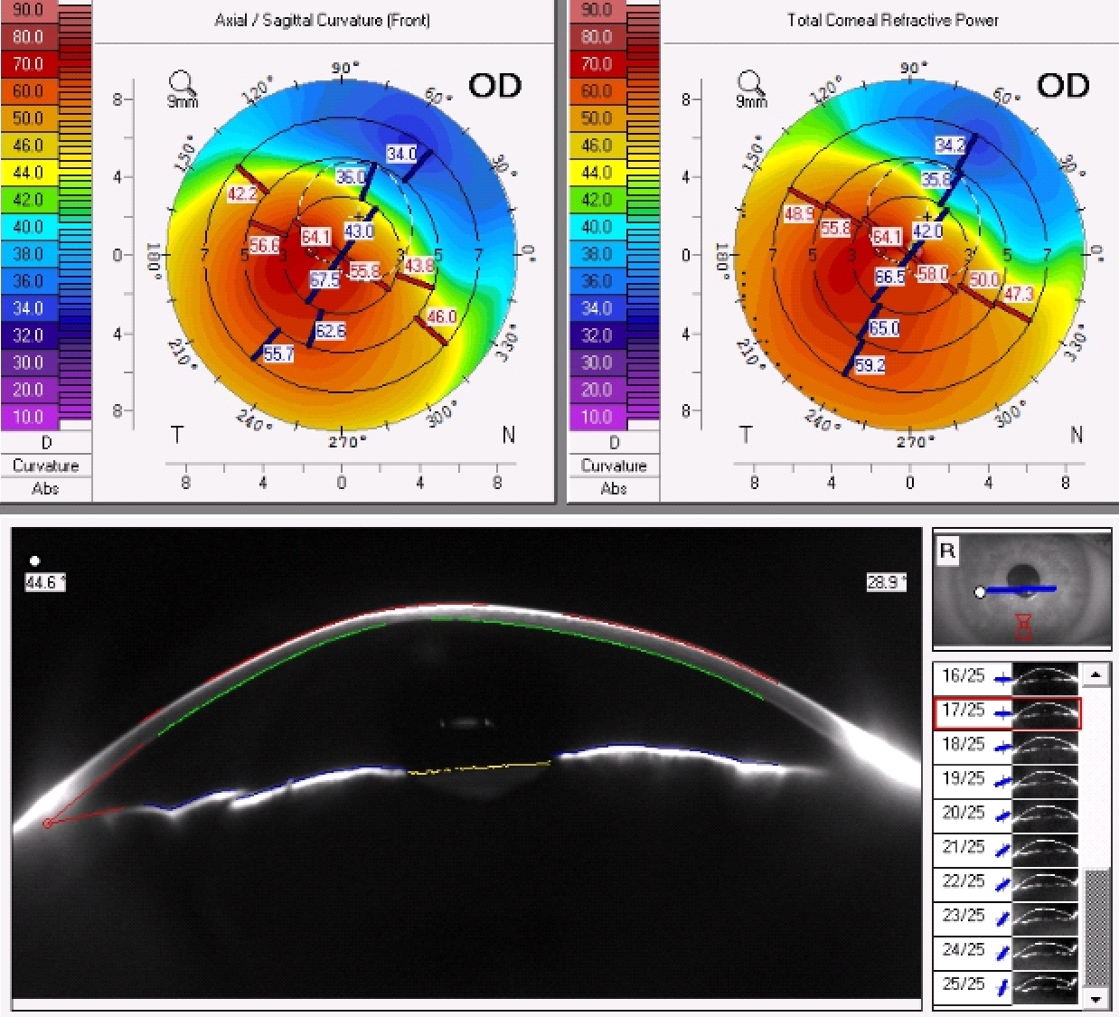 keratoconus