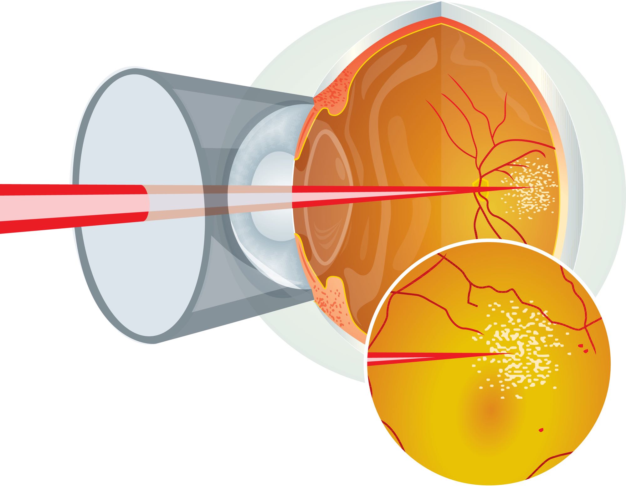 retinal laser