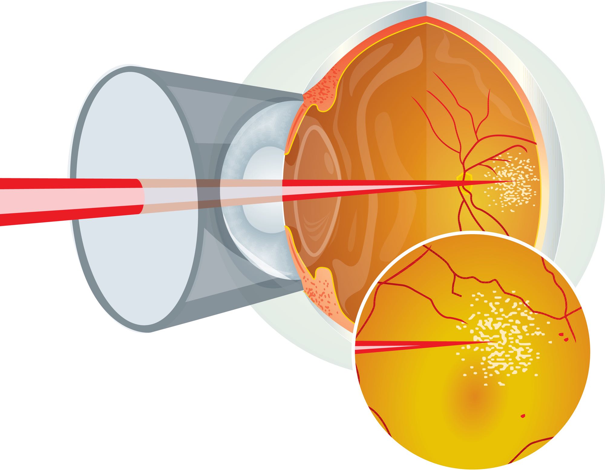 retinal laser